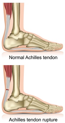 Diagram of an achilles tendon rupture