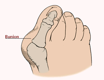 Bunions - symptoms, causes and treatment | Southern Cross NZ