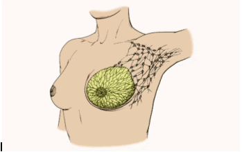 Diagram of human breasts, showing breast cancer