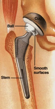 Hip replacement diagram