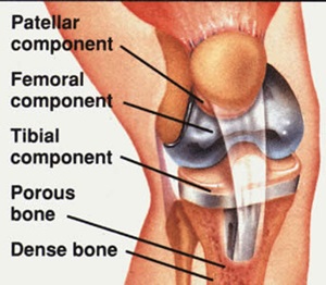 A diagram of a prosthetic knee replacement